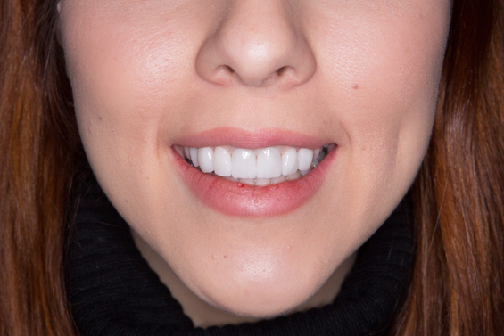 Thinking about teeth whitening? Here’s a useful fact sheet written by the ADA